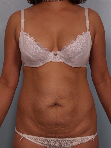 Image5 - Before image of Liposuction in Beverly Hills by Dr. Cohen.