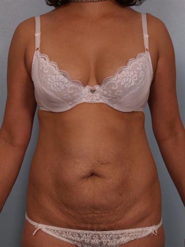 Power Assisted Liposuction Before & After Gallery - Patient 1310705 - Image 1