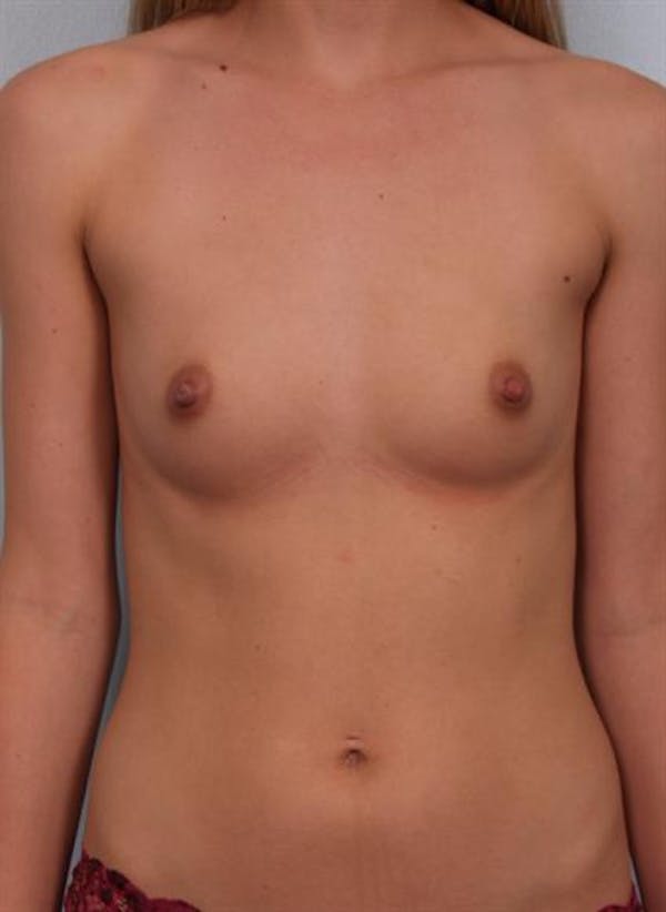 Breast Augmentation Gallery - Patient 1310702 - Image 3