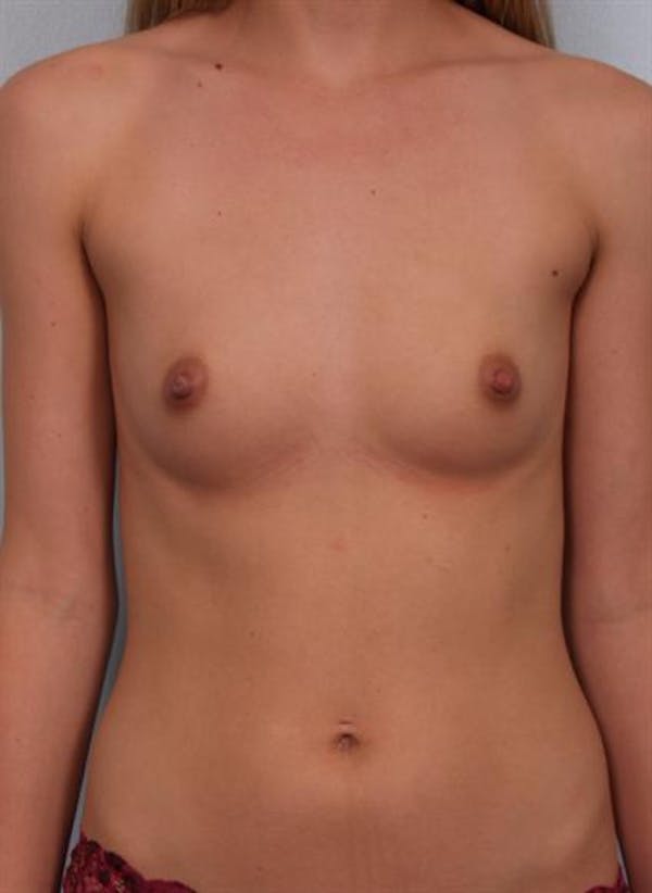 Breast Augmentation Before & After Gallery - Patient 1310702 - Image 3