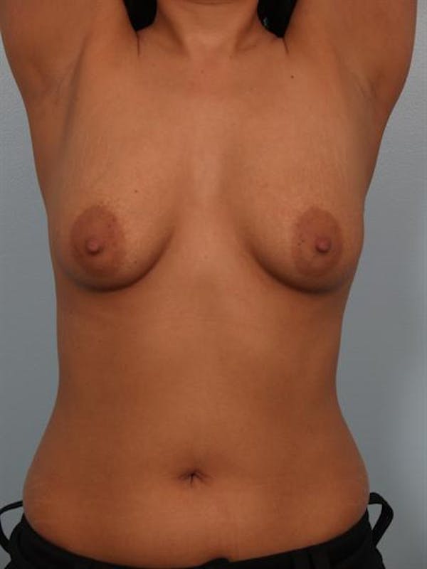 Breast Lift Gallery - Patient 1310700 - Image 5