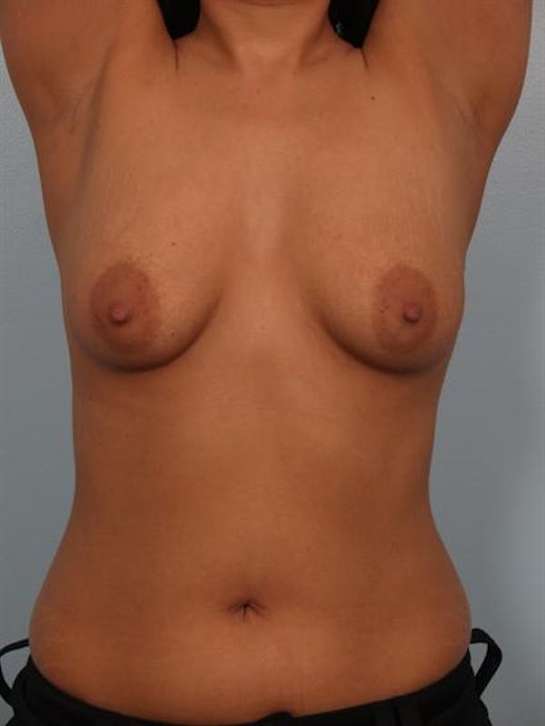 Breast Lift Before & After Gallery - Patient 1310700 - Image 5