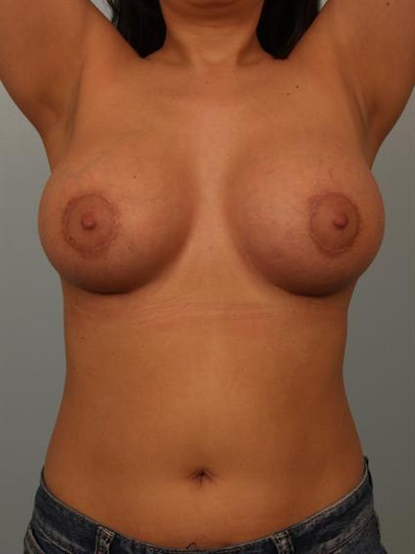 Breast Lift Before & After Gallery - Patient 1310700 - Image 6
