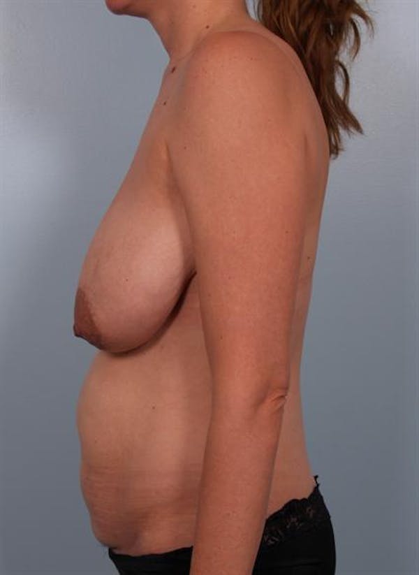 Breast Reduction Before & After Gallery - Patient 1310703 - Image 3