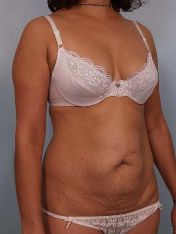 Power Assisted Liposuction Before & After Gallery - Patient 1310705 - Image 3