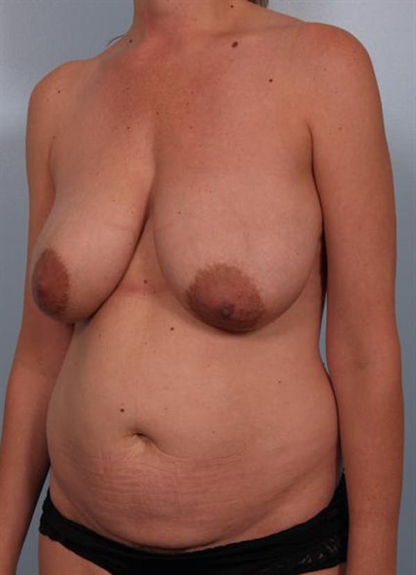 Breast Reduction Before & After Gallery - Patient 1310703 - Image 5