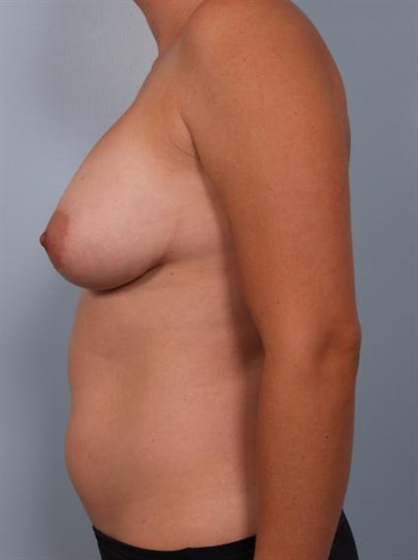 Breast Lift Before & After Gallery - Patient 1310706 - Image 3