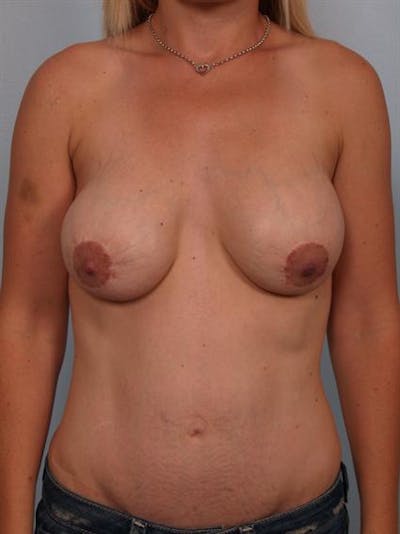 Complex Breast Revision Before & After Gallery - Patient 1310707 - Image 1