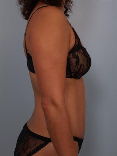 Power Assisted Liposuction Before & After Gallery - Patient 1310705 - Image 6