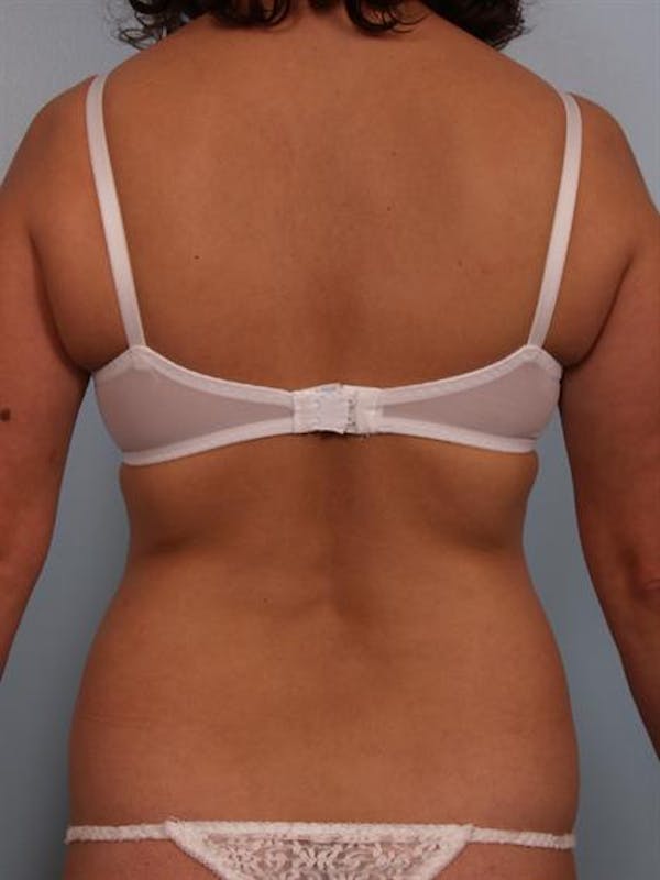 Power Assisted Liposuction Before & After Gallery - Patient 1310705 - Image 7