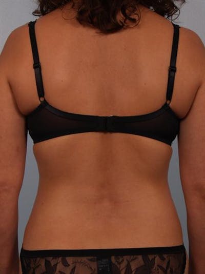 Power Assisted Liposuction Before & After Gallery - Patient 1310705 - Image 8