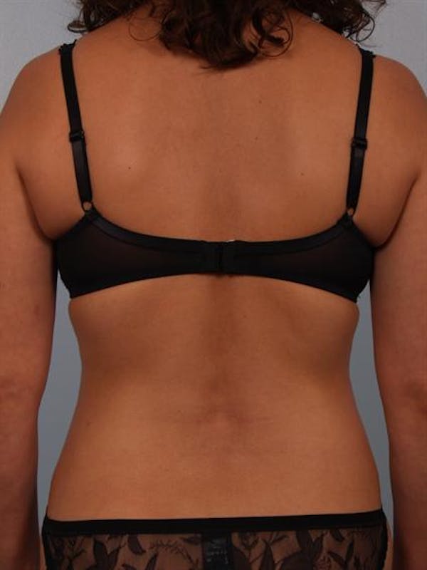 Power Assisted Liposuction Gallery - Patient 1310705 - Image 8