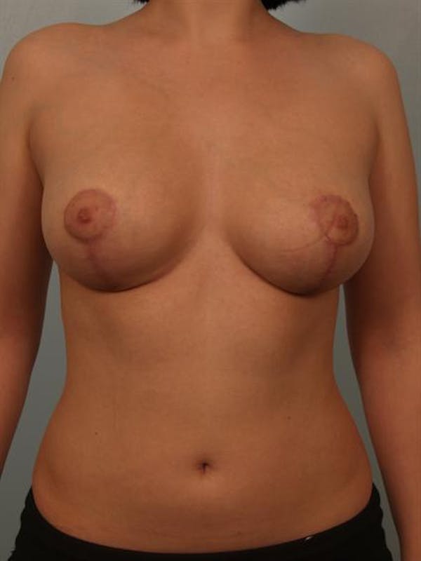 Breast Reduction Before & After Gallery - Patient 1310708 - Image 2