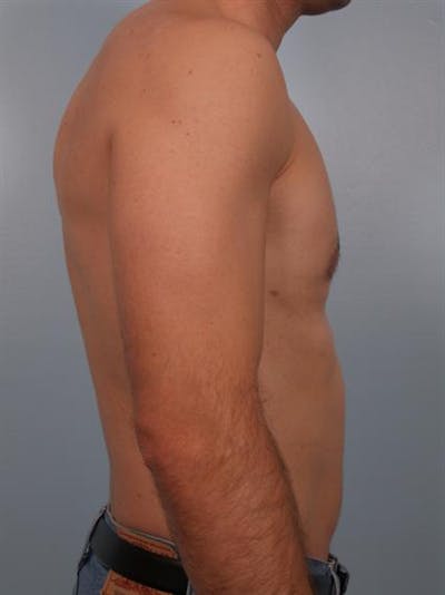 Power Assisted Liposuction Before & After Gallery - Patient 1310710 - Image 2