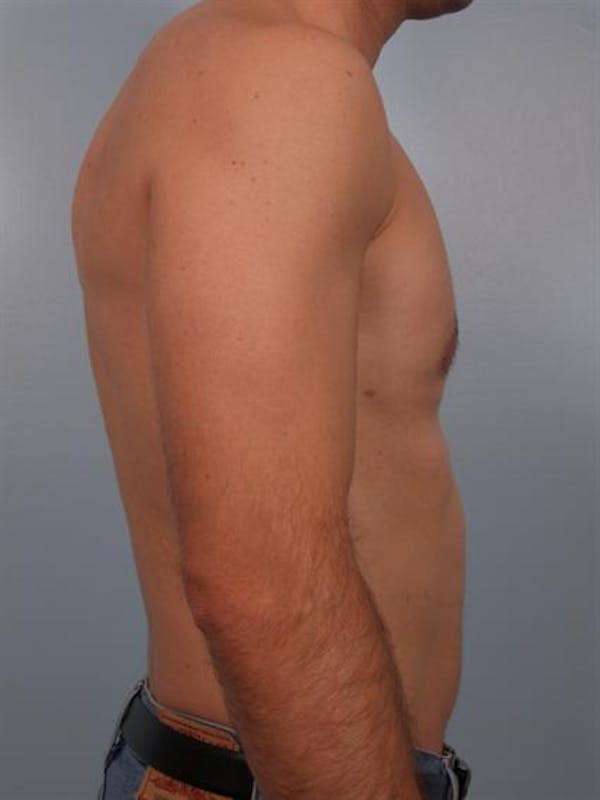 Power Assisted Liposuction Gallery - Patient 1310710 - Image 2