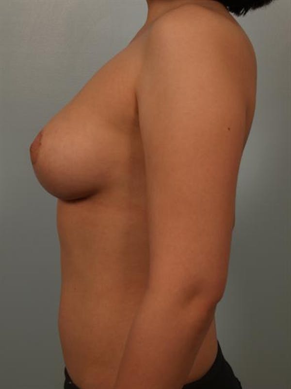 Breast Reduction Before & After Gallery - Patient 1310708 - Image 6