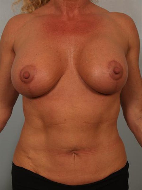 Breast Augmentation Before & After Gallery - Patient 1310711 - Image 6