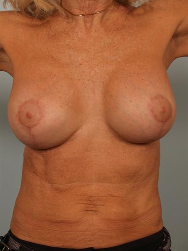 Complex Breast Revision Before & After Gallery - Patient 1310713 - Image 2