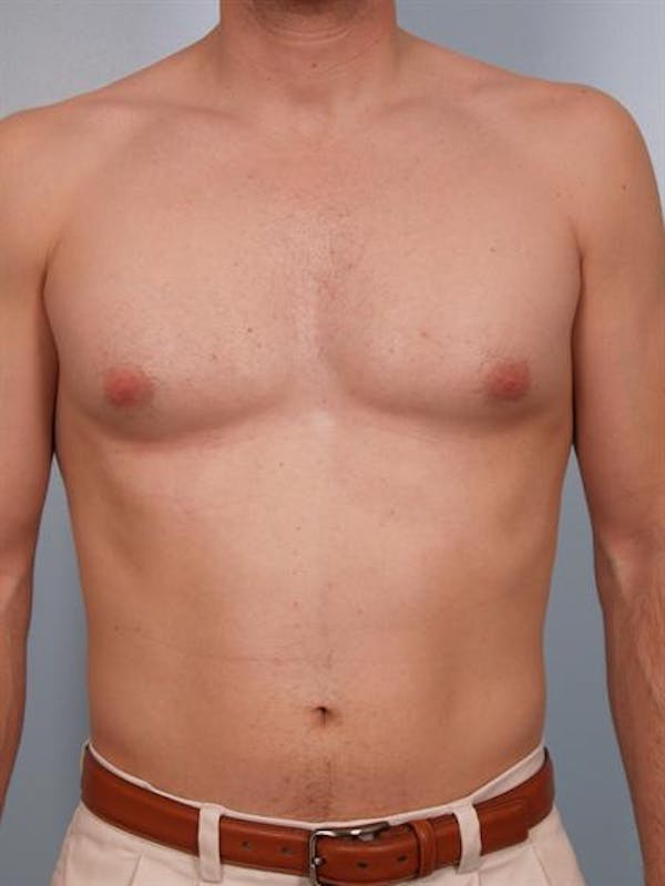 Power Assisted Liposuction Before & After Gallery - Patient 1310710 - Image 5