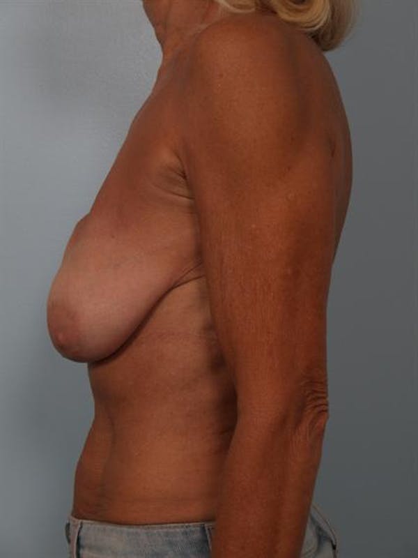 Complex Breast Revision Before & After Gallery - Patient 1310713 - Image 3
