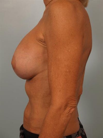 Complex Breast Revision Before & After Gallery - Patient 1310713 - Image 4
