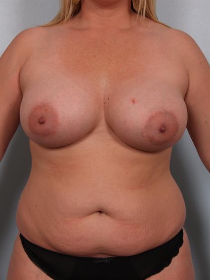 Image1 - Before image of Mommy Makeover in Beverly Hills by Dr. Cohen.