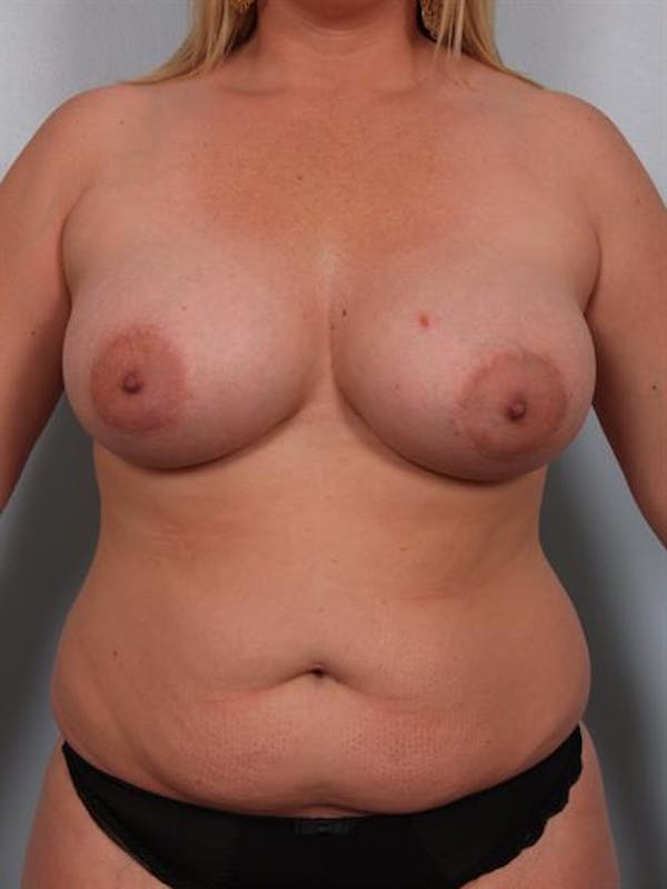 Mommy Makeover Before & After Gallery - Patient 1310715 - Image 1