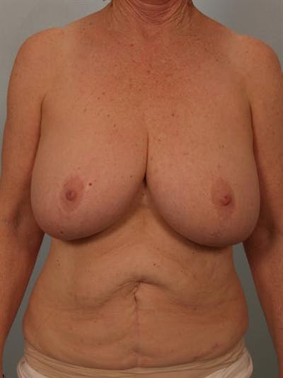 Breast Reduction Before & After Gallery - Patient 1310714 - Image 1