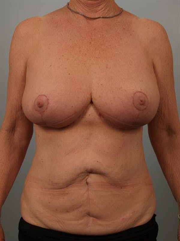 Breast Reduction Before & After Gallery - Patient 1310714 - Image 2