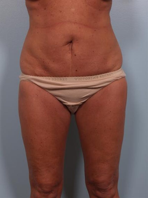 Power Assisted Liposuction Before & After Gallery - Patient 1310716 - Image 5