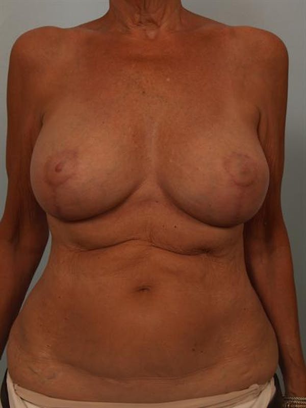Complex Breast Revision Before & After Gallery - Patient 1310718 - Image 2