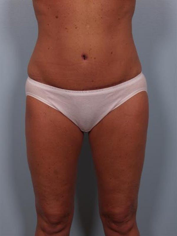 Power Assisted Liposuction Before & After Gallery - Patient 1310716 - Image 6