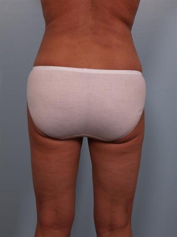 Power Assisted Liposuction Before & After Gallery - Patient 1310716 - Image 8