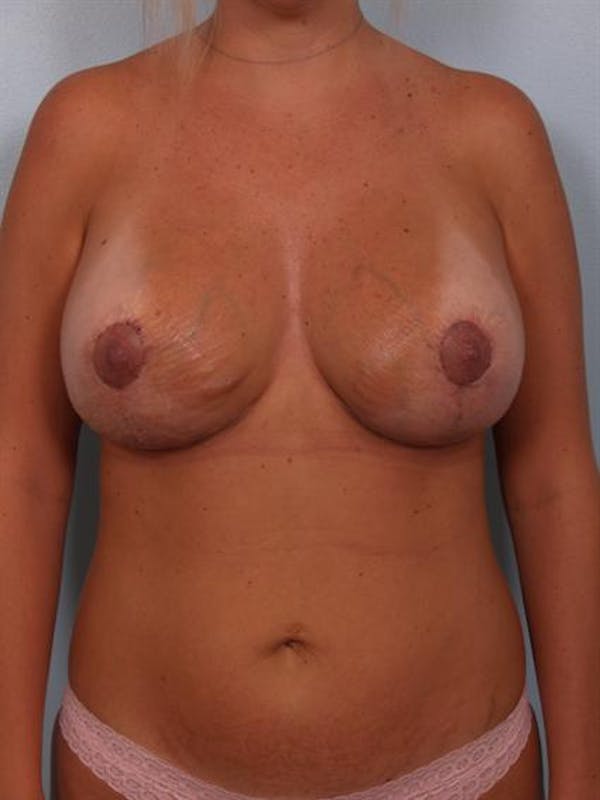 Breast Lift Gallery - Patient 1310717 - Image 2