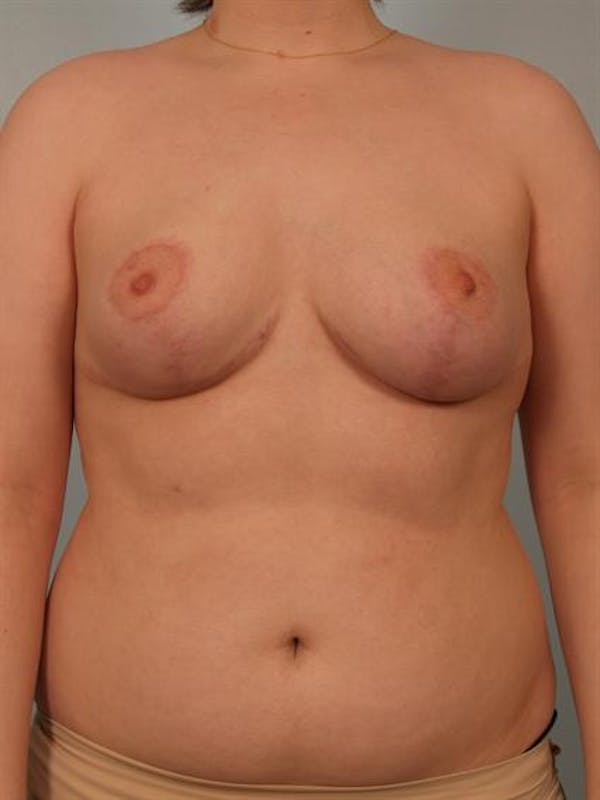 Breast Reduction Gallery - Patient 1310720 - Image 2