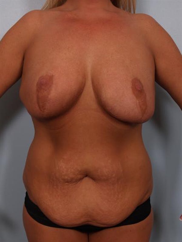 Breast Reduction Before & After Gallery - Patient 1310726 - Image 1