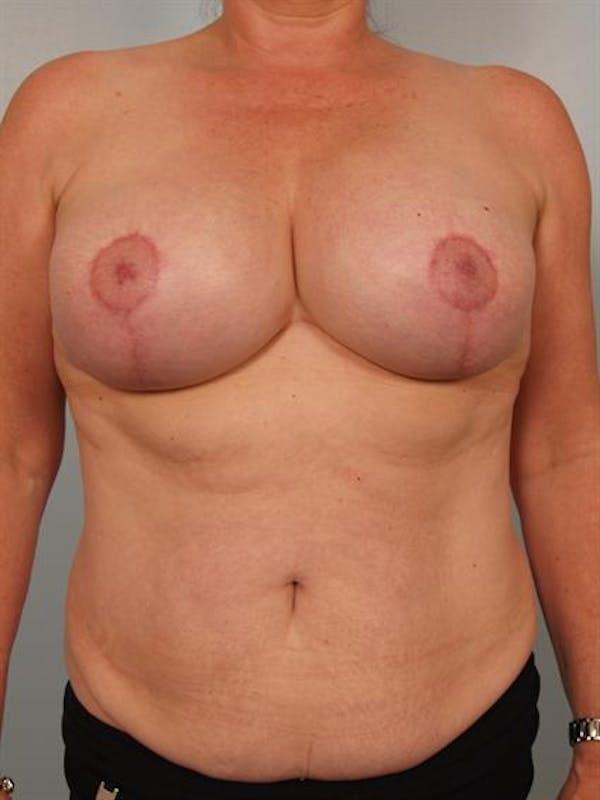 Breast Lift Before & After Gallery - Patient 1310723 - Image 2