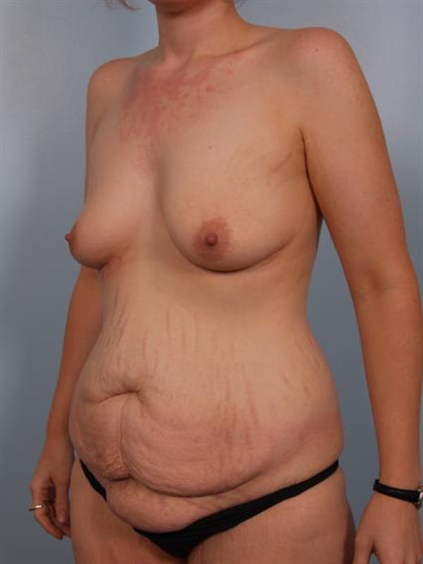 Mommy Makeover Before & After Gallery - Patient 1310725 - Image 3