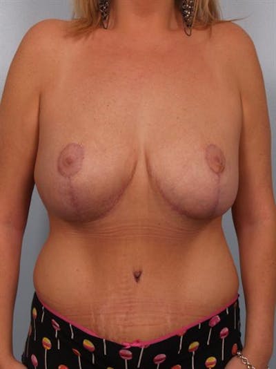 Breast Reduction Before & After Gallery - Patient 1310726 - Image 2