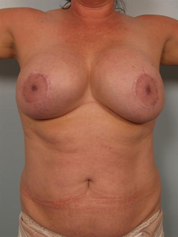 Breast Lift Gallery - Patient 1310723 - Image 5