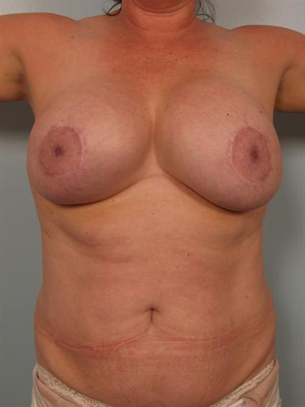 Breast Lift Before & After Gallery - Patient 1310723 - Image 5