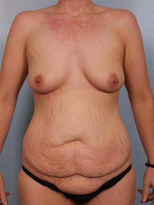 Mommy Makeover Before & After Gallery - Patient 1310725 - Image 1