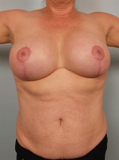 Breast Lift Before & After Gallery - Patient 1310723 - Image 6