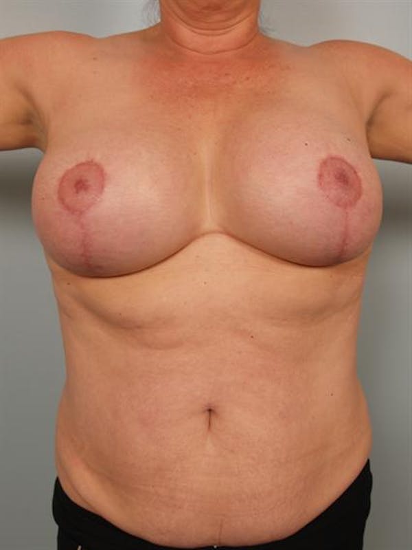 Breast Lift Gallery - Patient 1310723 - Image 6