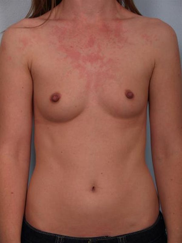 Breast Augmentation Gallery - Patient 1310727 - Image 5
