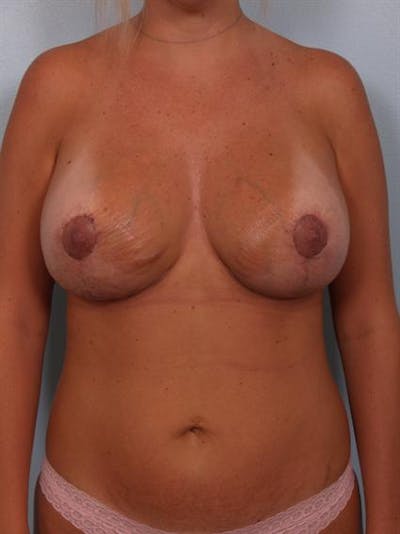 Complex Breast Revision Before & After Gallery - Patient 1310724 - Image 2