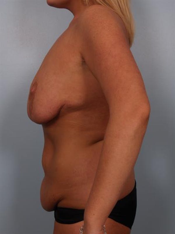 Breast Reduction Before & After Gallery - Patient 1310726 - Image 5