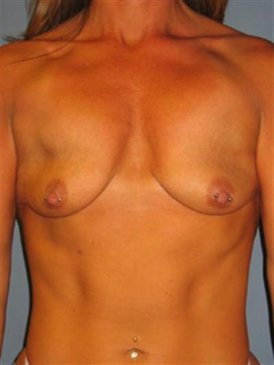 Breast Lift Before & After Gallery - Patient 1310730 - Image 1