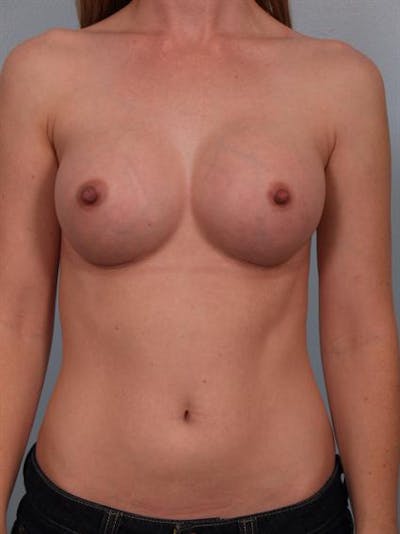 Breast Augmentation Before & After Gallery - Patient 1310727 - Image 6