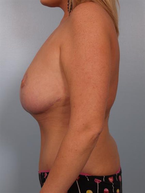 Breast Reduction Before & After Gallery - Patient 1310726 - Image 6